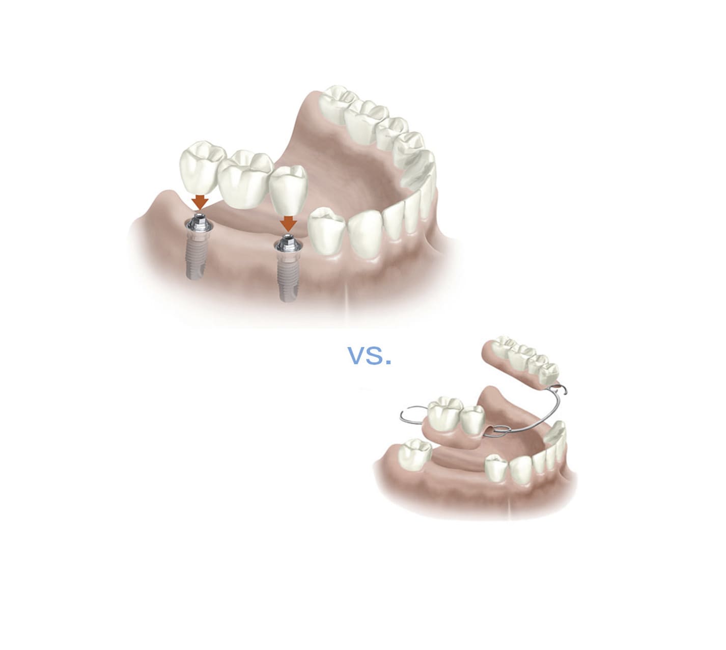 Beneficios de los implantes dentales