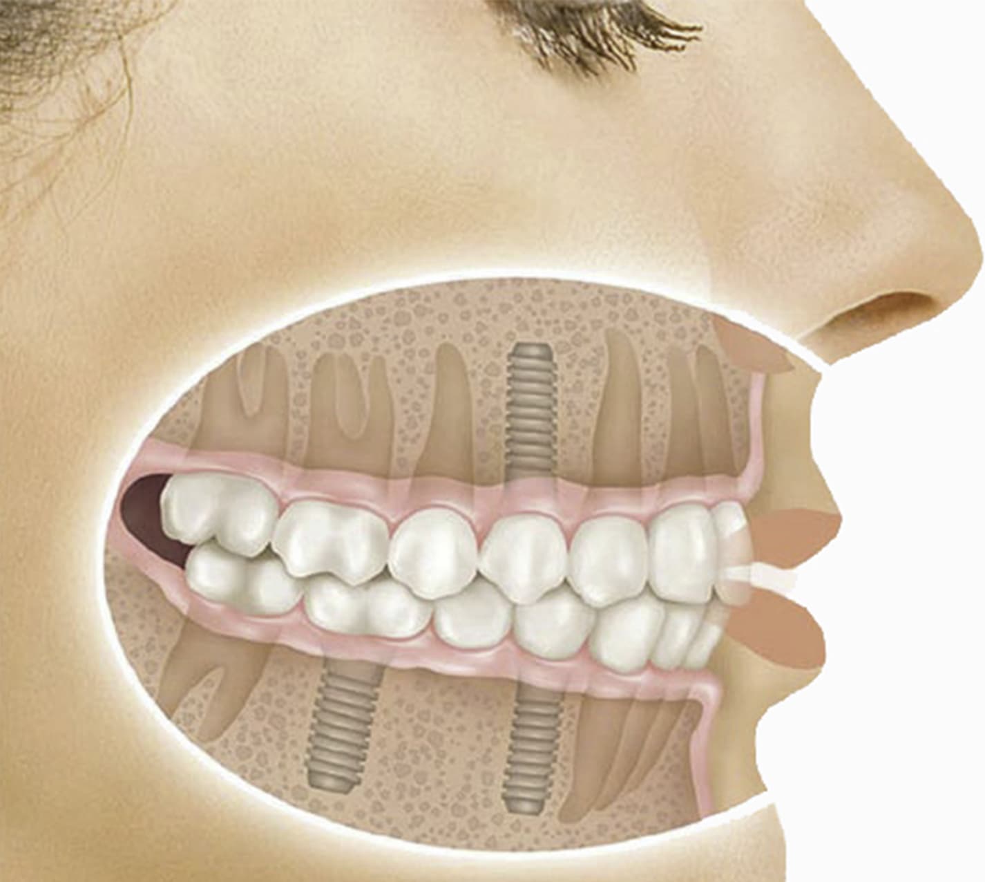 Implantes dentales en ambas arcadas