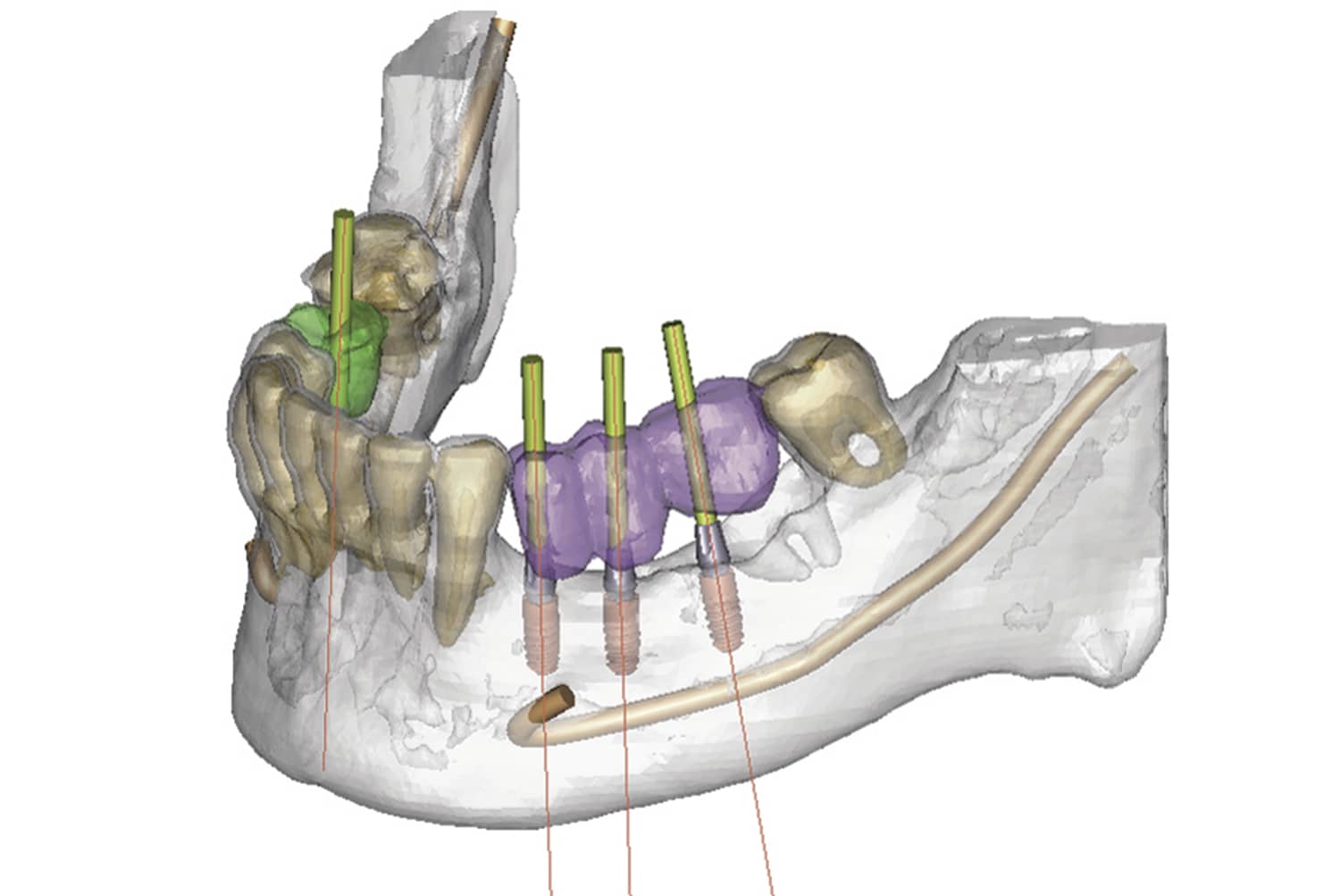 Cirugía guiada sobre implantes