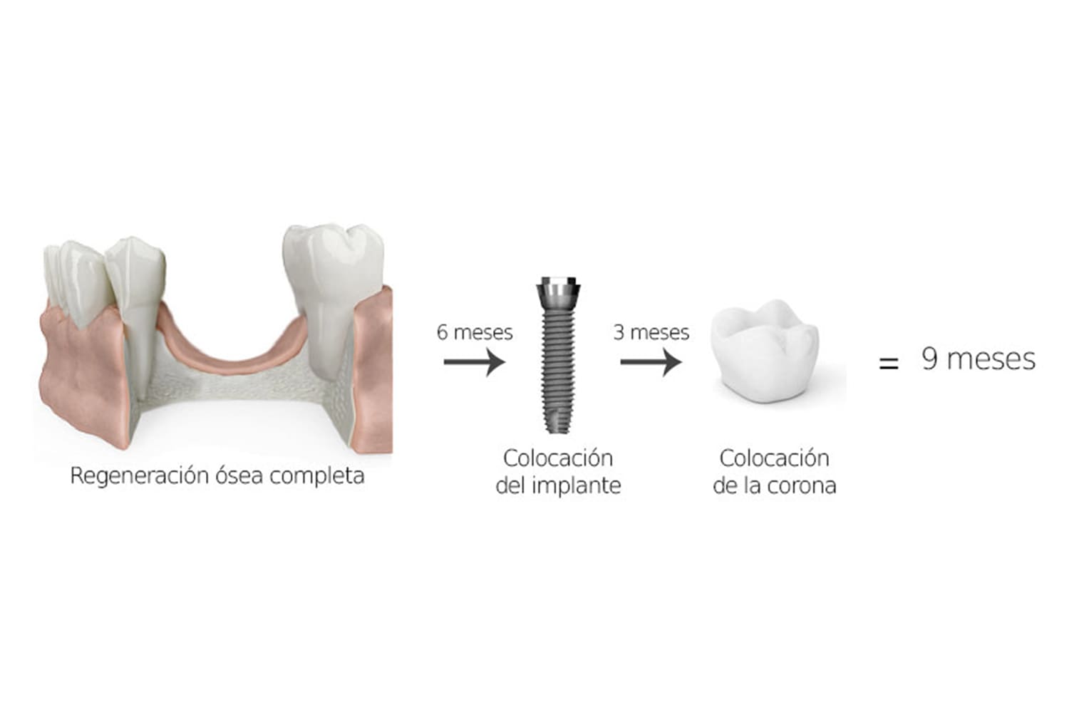 Colocación de implantes dentales con regeneración ósea completa