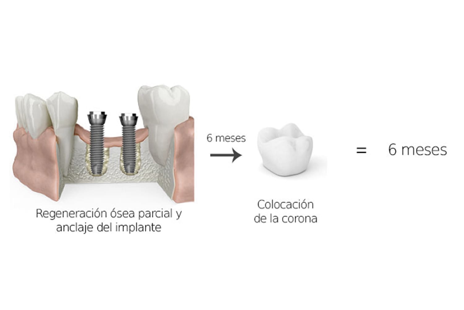 Colocación de implantes dentales con regeneración ósea parcial