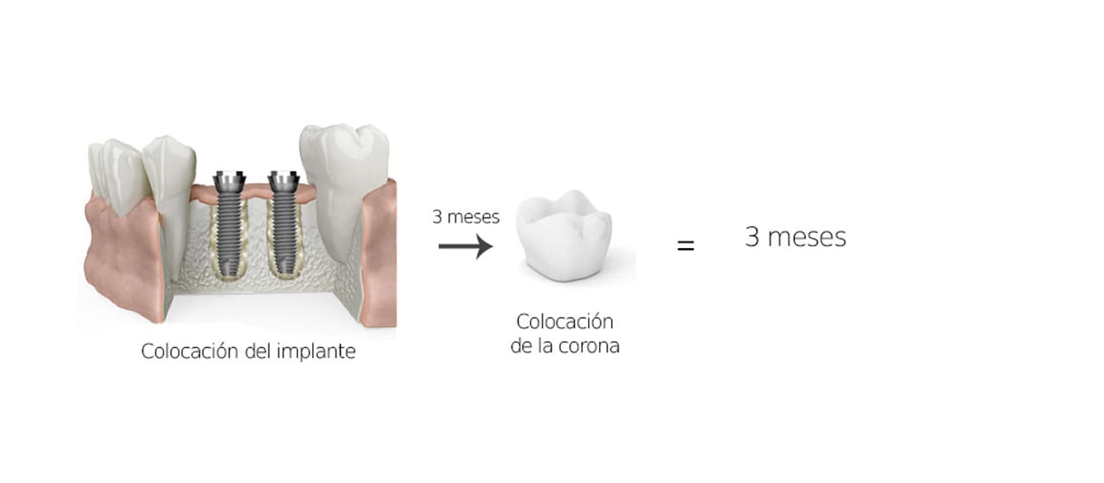 Colocación corona dental sin regeneración ósea
