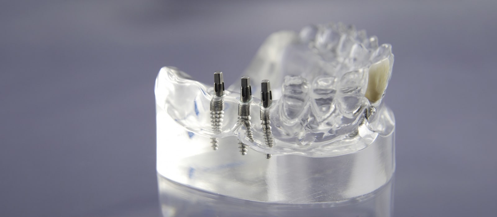 Materiales implantes dentales
