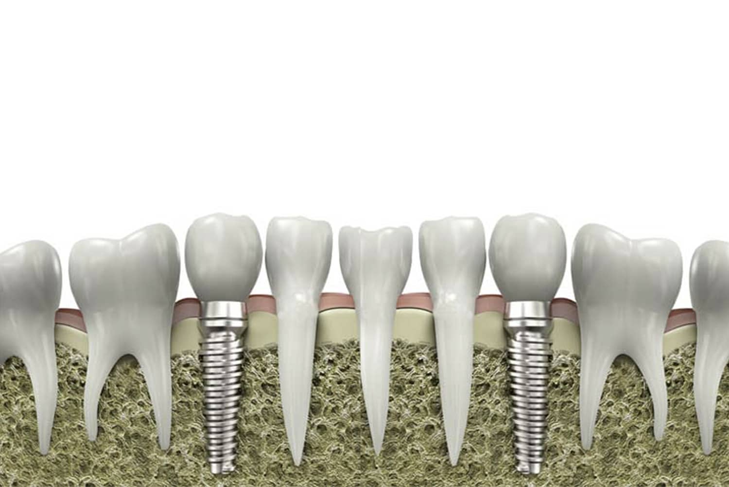 Colocación de implantes tras extracción dentaria