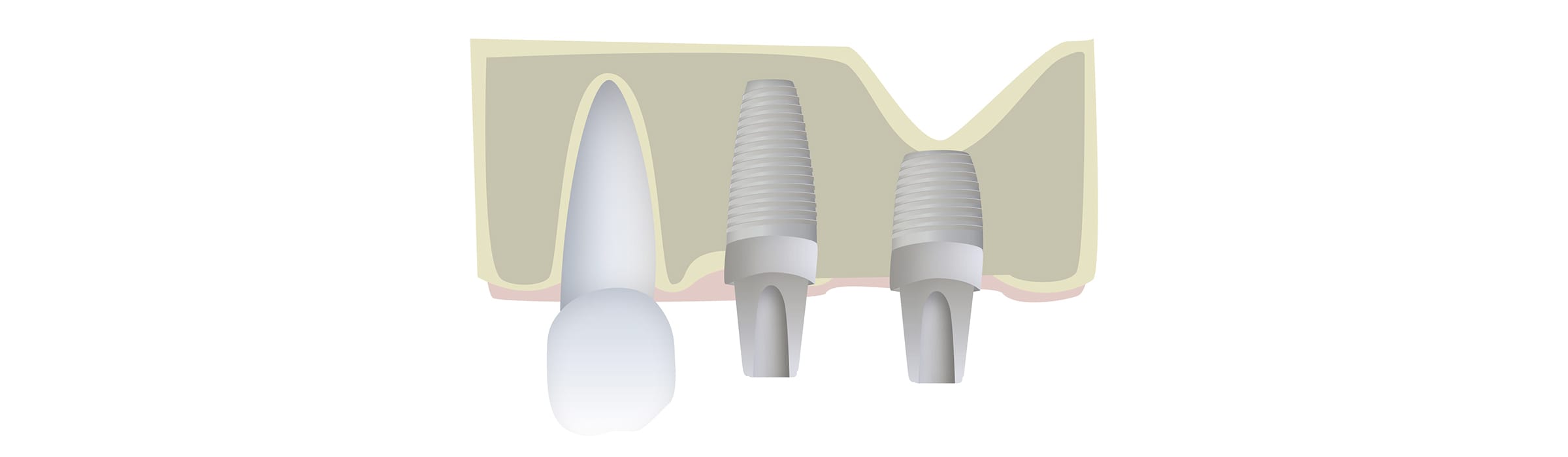Mini implante dental