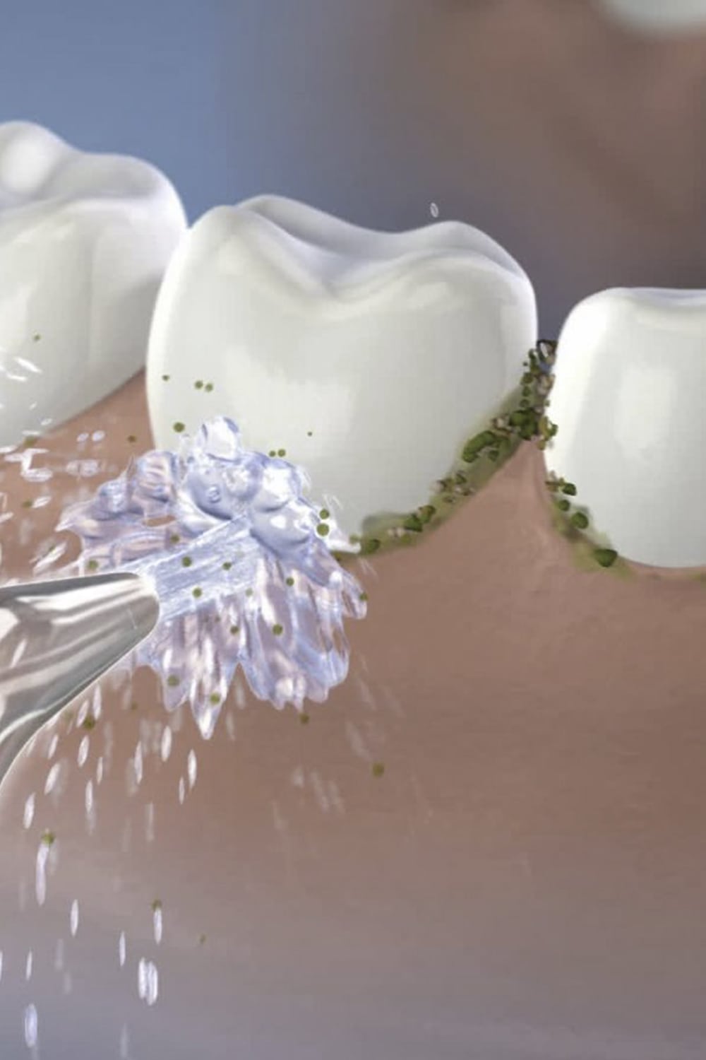 Higiene con implantes dentales
