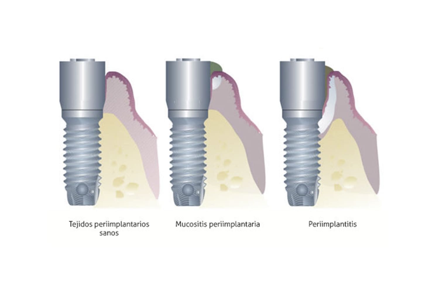 Qué es la periimplantatis