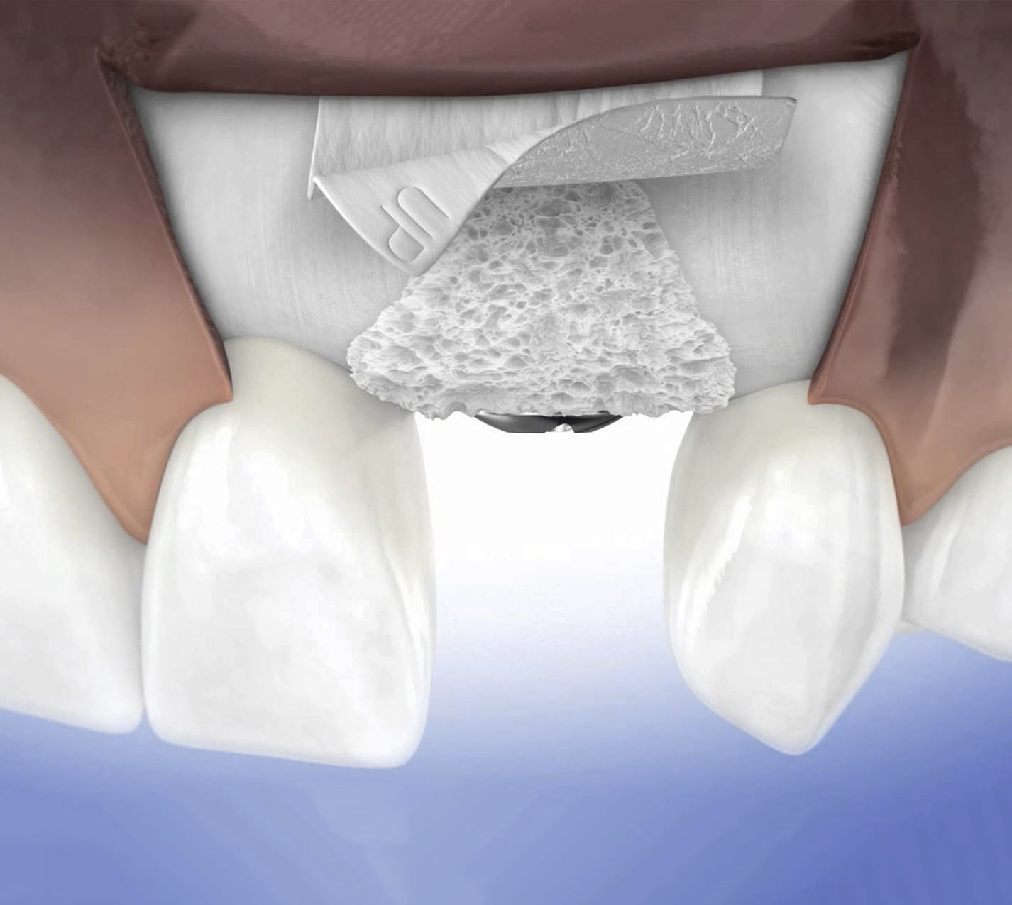 Injerto óseo en implantes dentales