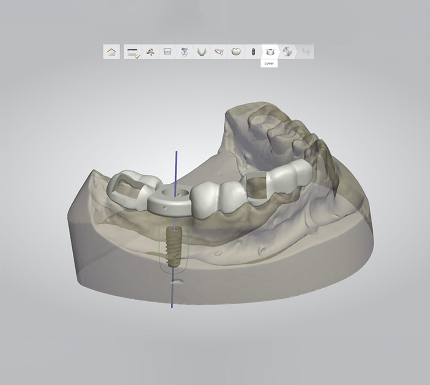 Implantes dentales con cirugía guiada