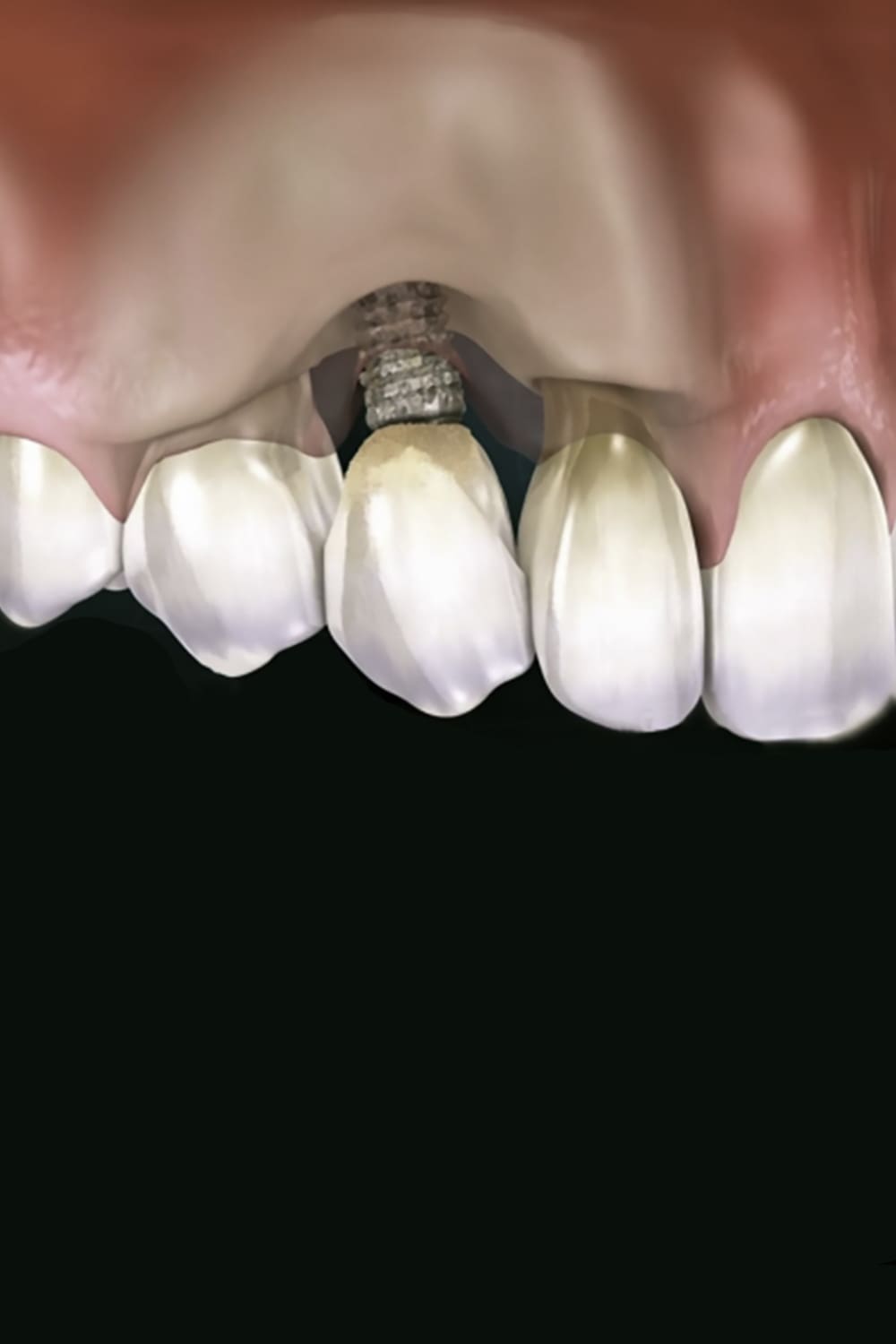 Rechazo implante dental