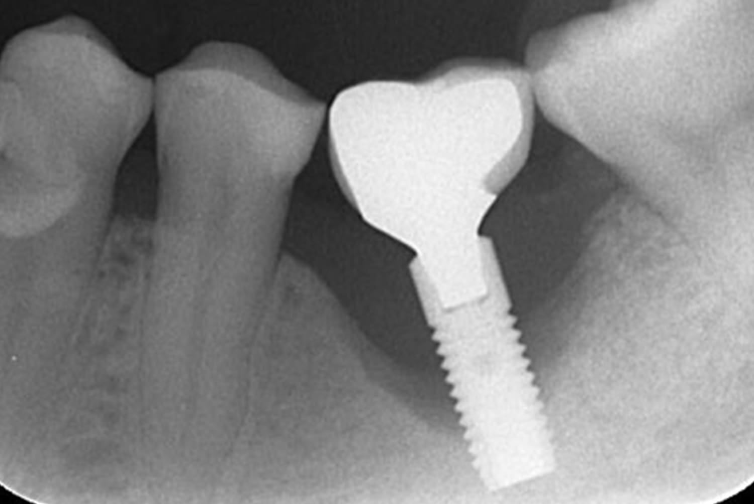 Периимплантит рентген снимок