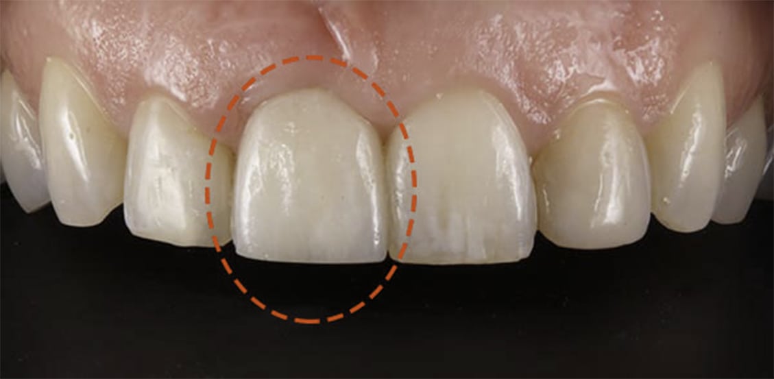 Resultado después de implantes dentales