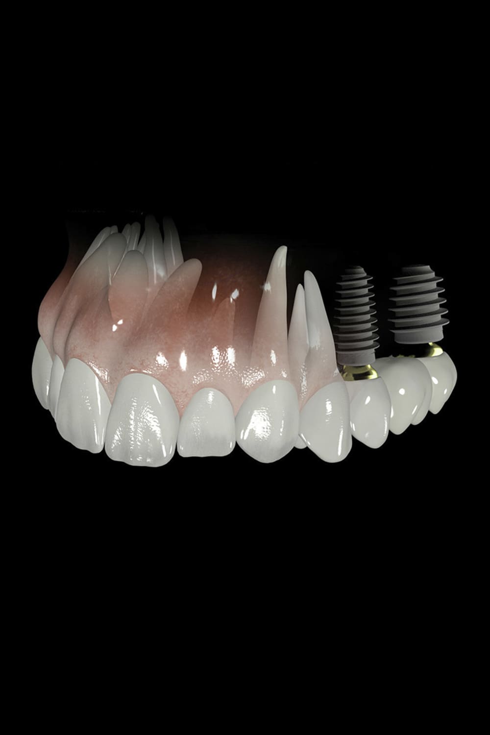 Implantes dentales estéticos
