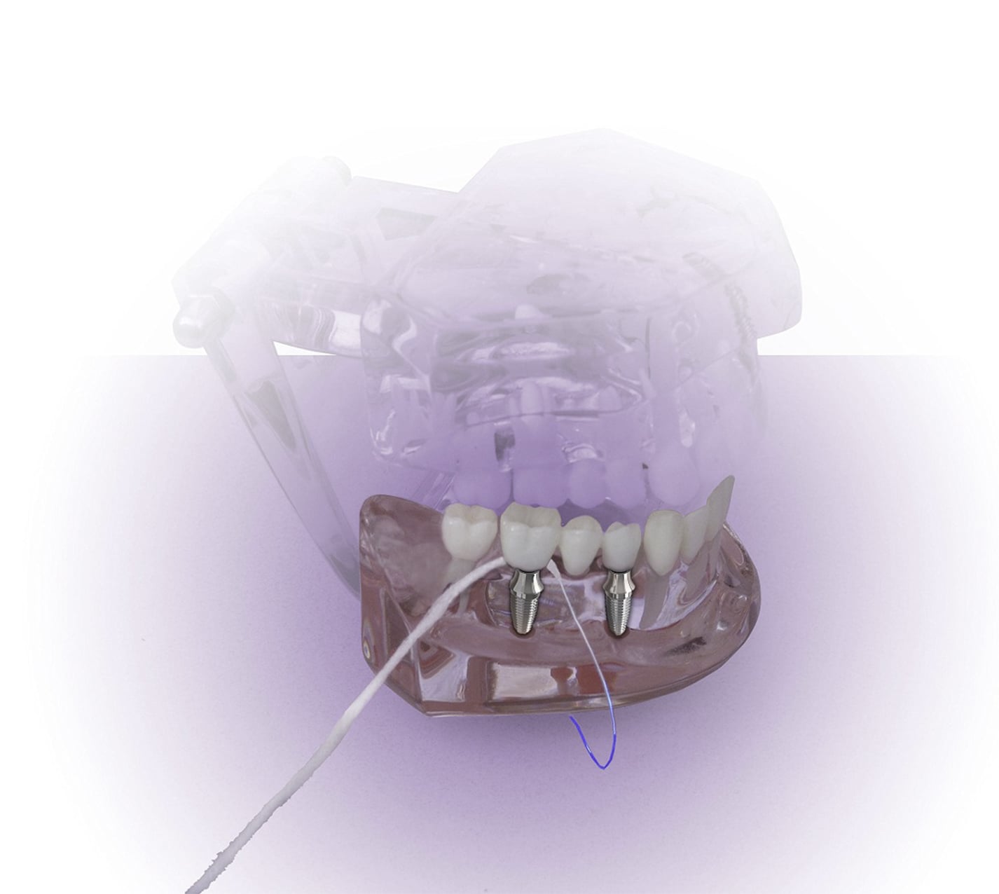 Implantes dentales y buen aliento