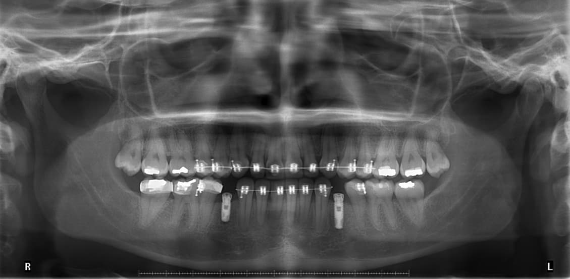 Ortodoncia e implantes dentales