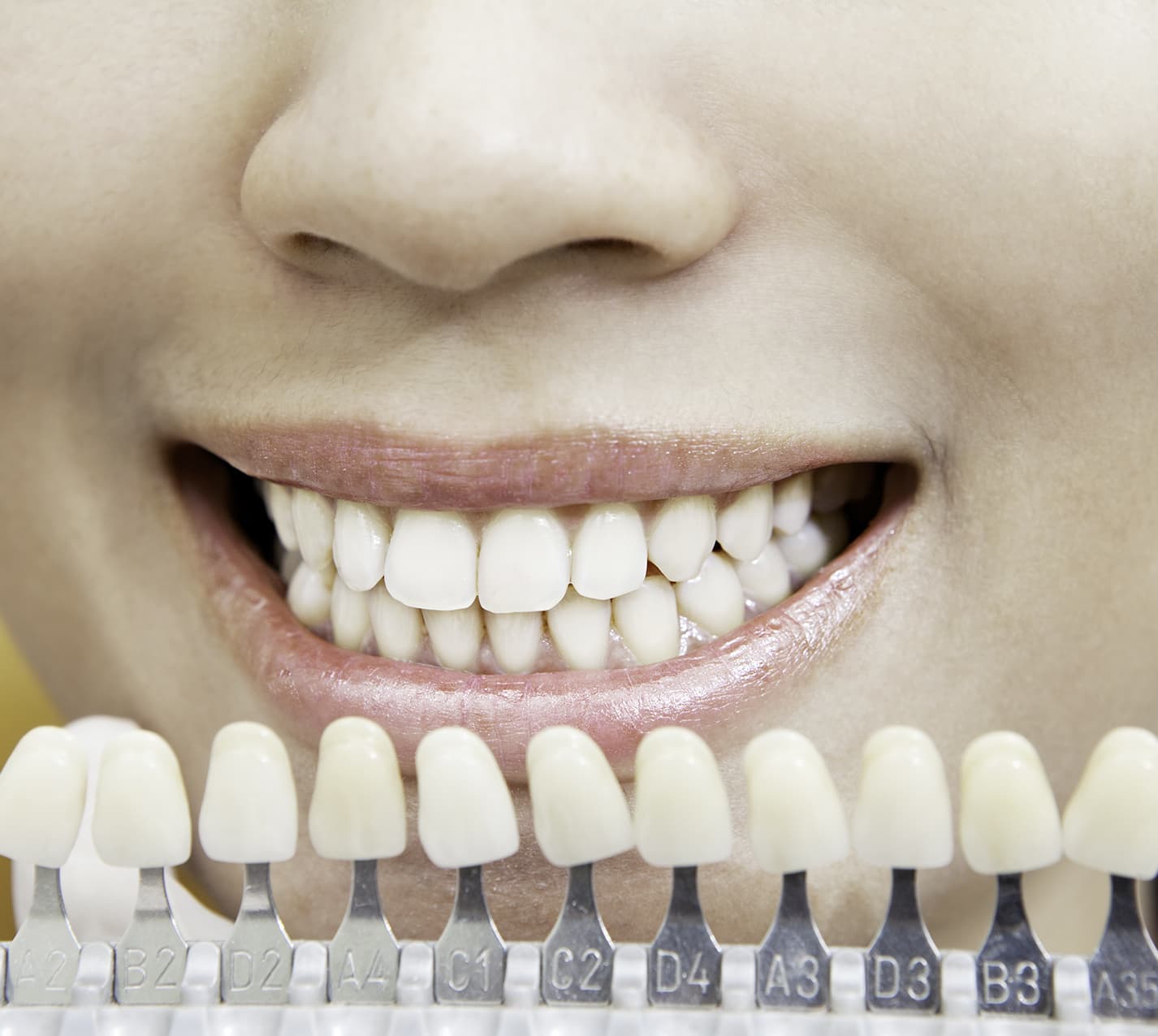 Blanqueamiento implantes dentales