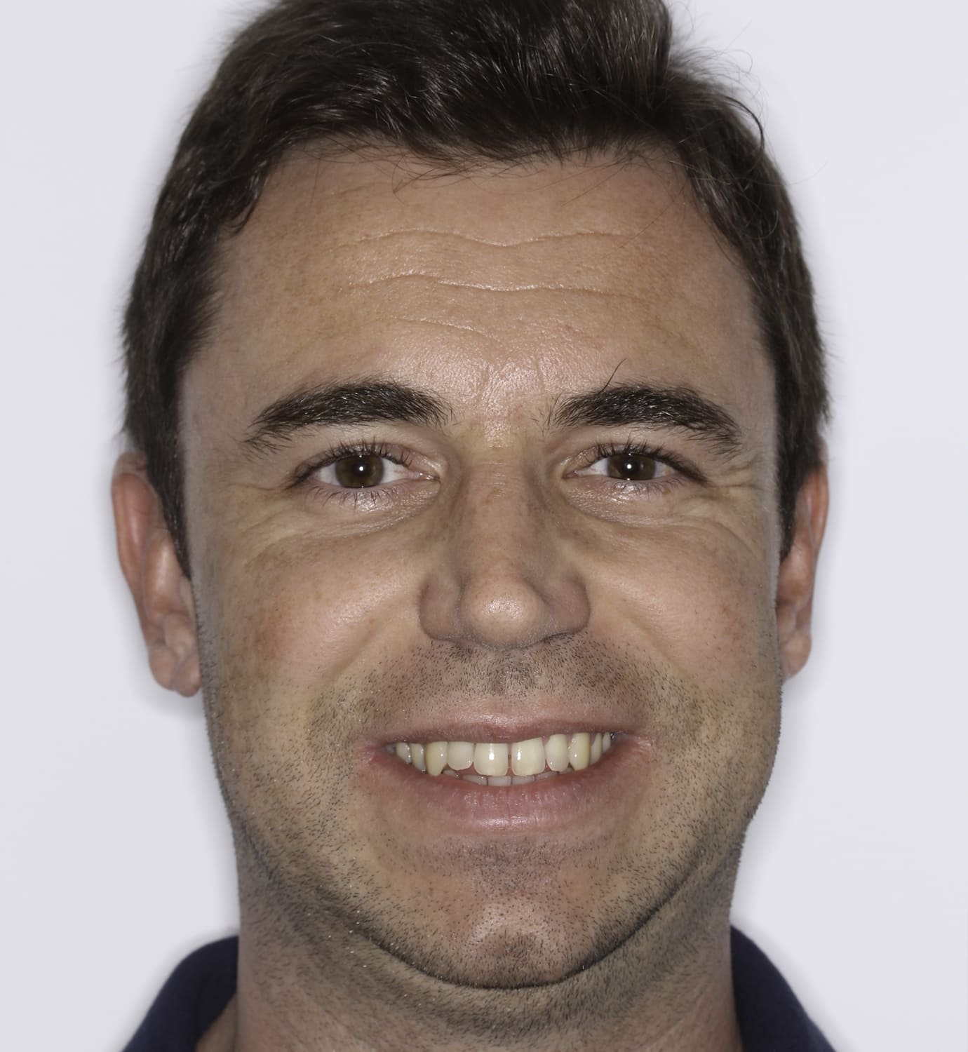 fotografía de sonrisa antes de ortodoncia