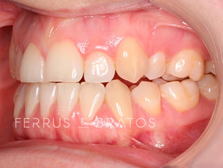 Antes