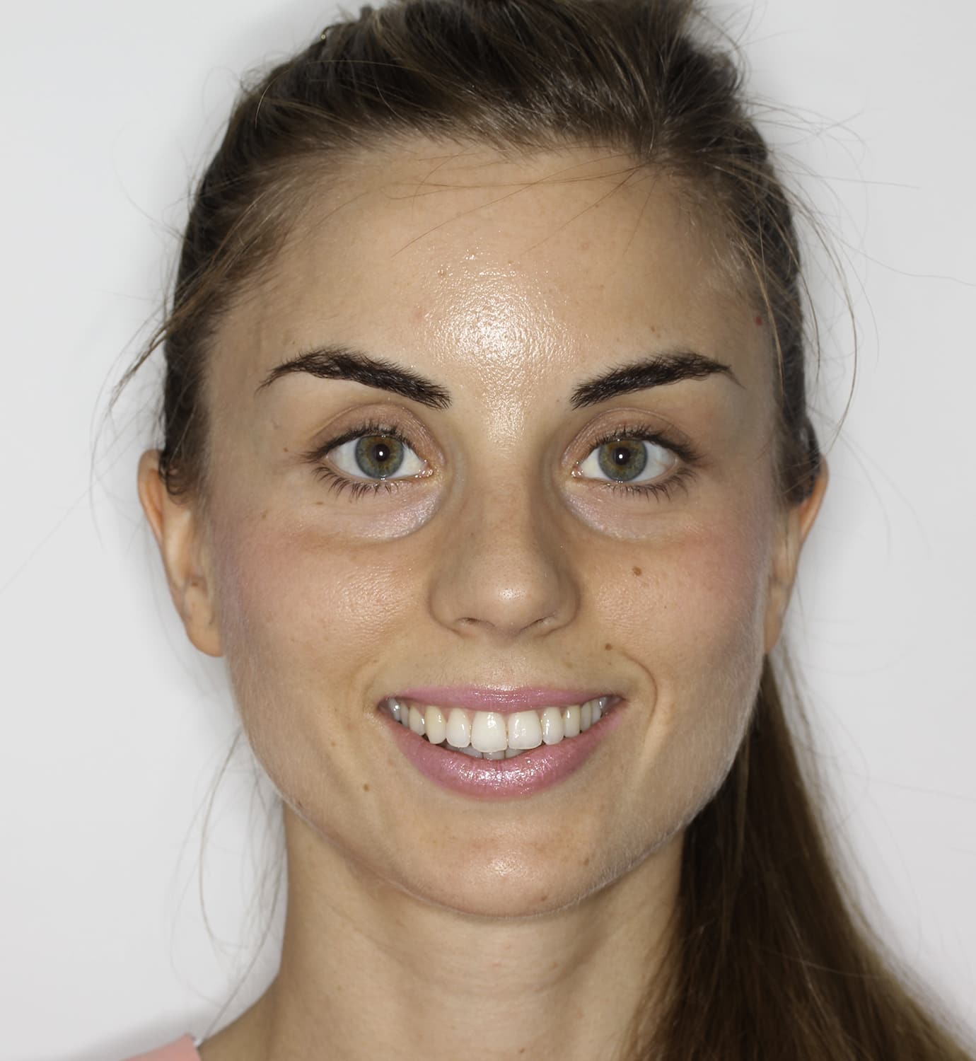 fotografía de después de ortodoncia con Invisalign