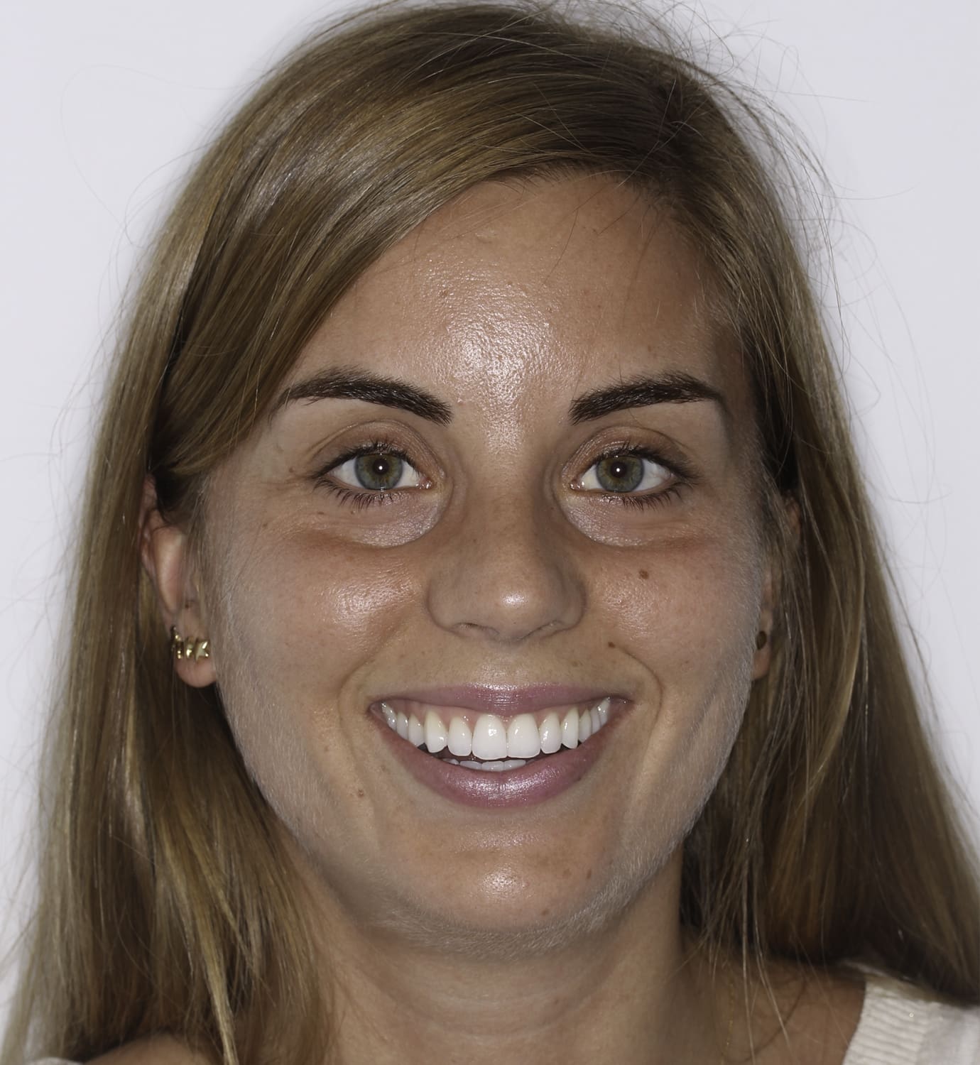 fotografía de antes de ortodoncia con Invisalign