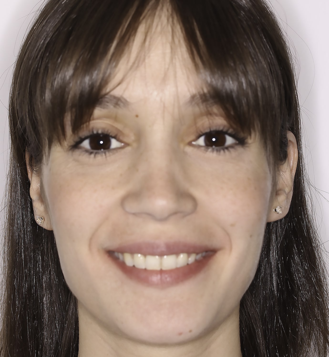 fotografía de después de ortodoncia con Invisalign