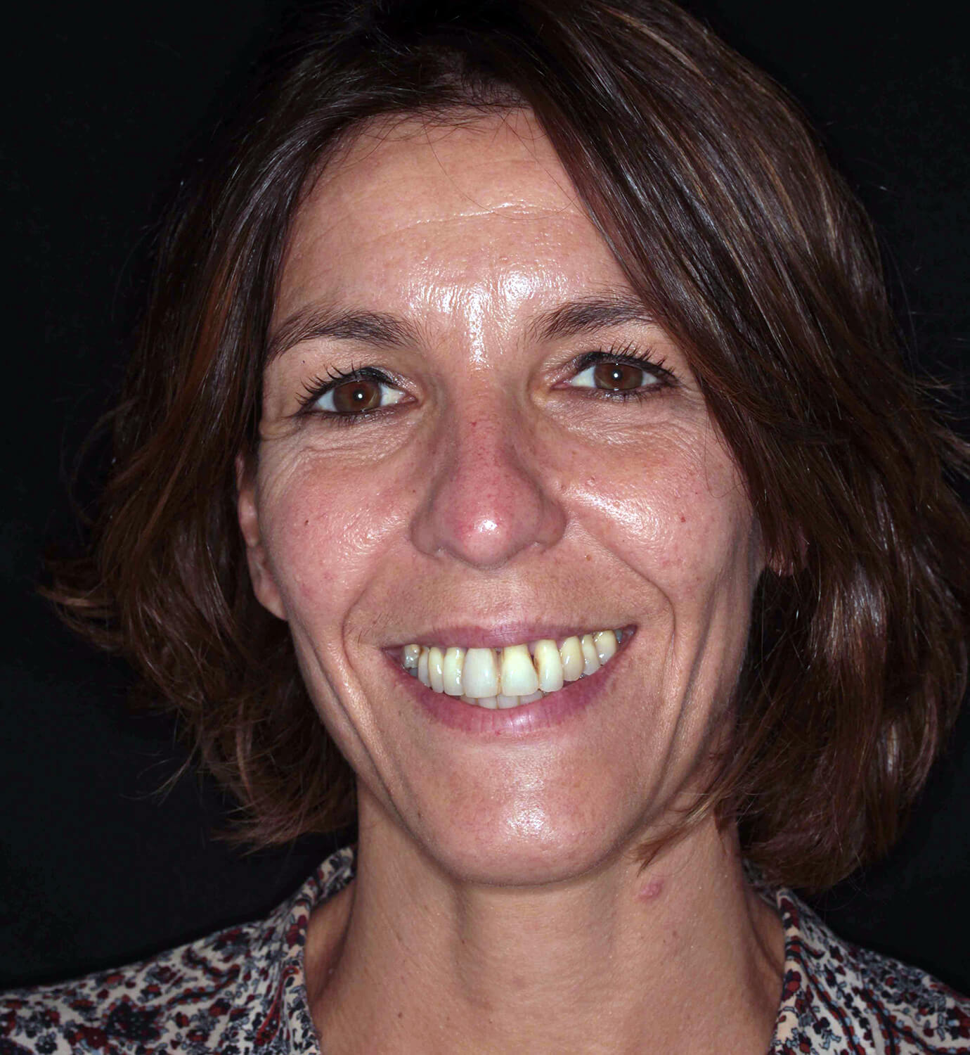 fotografía de antes de ortodoncia con Invisalign