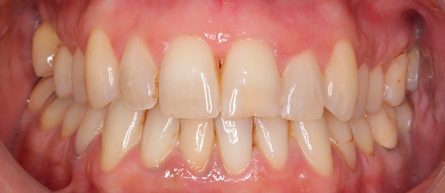Antes de Invisalign
