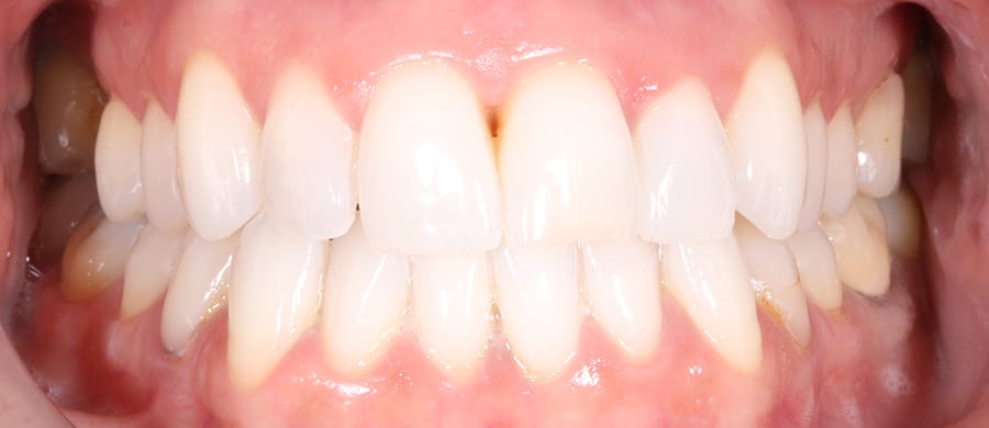 Después de Invisalign