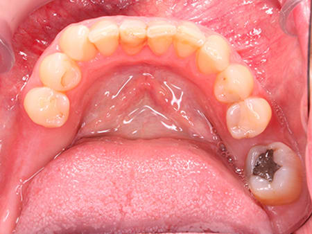 Antes