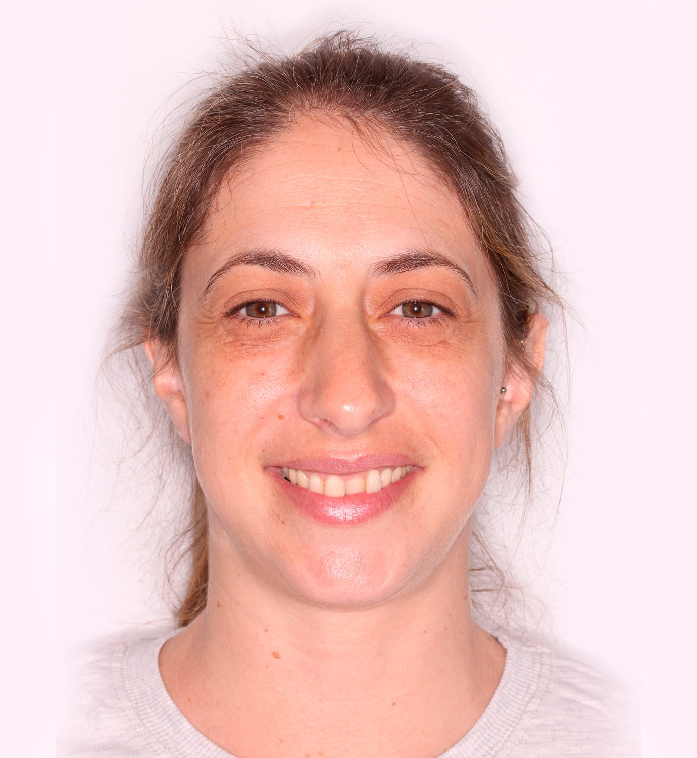 fotografía de antes de ortodoncia con Invisalign