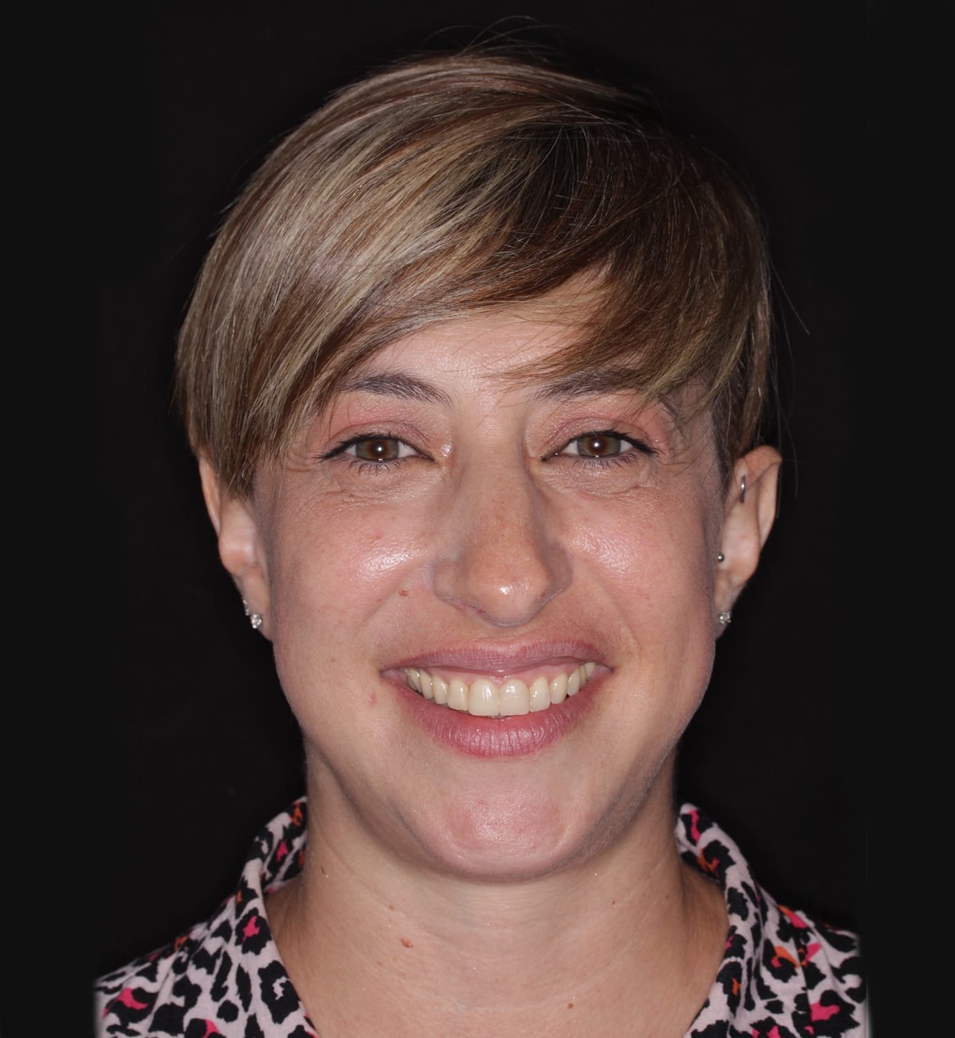 fotografía de después de ortodoncia con Invisalign