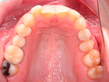 Antes