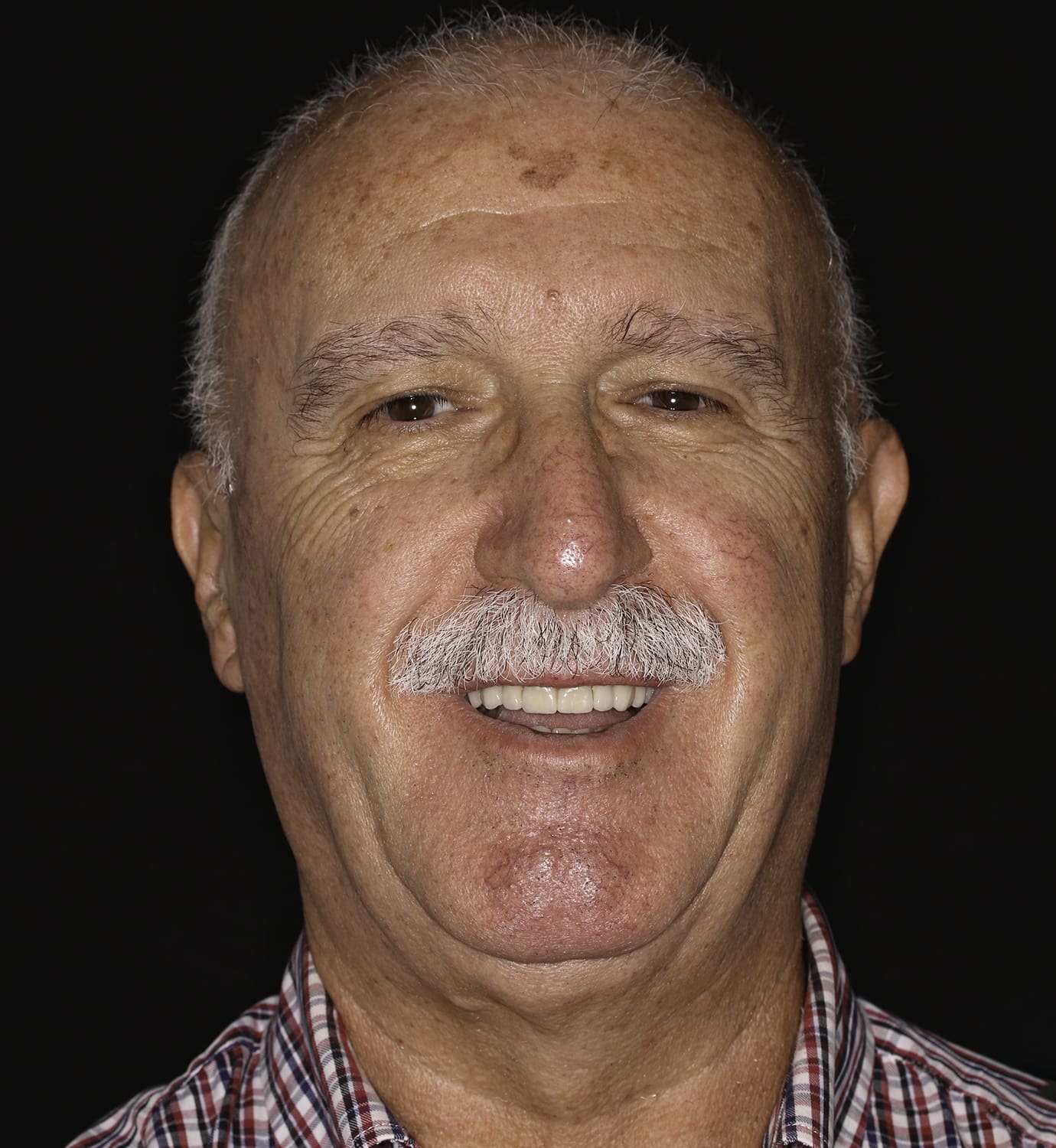 fotografía de después de caso de rehabilitación con prótesis híbrida