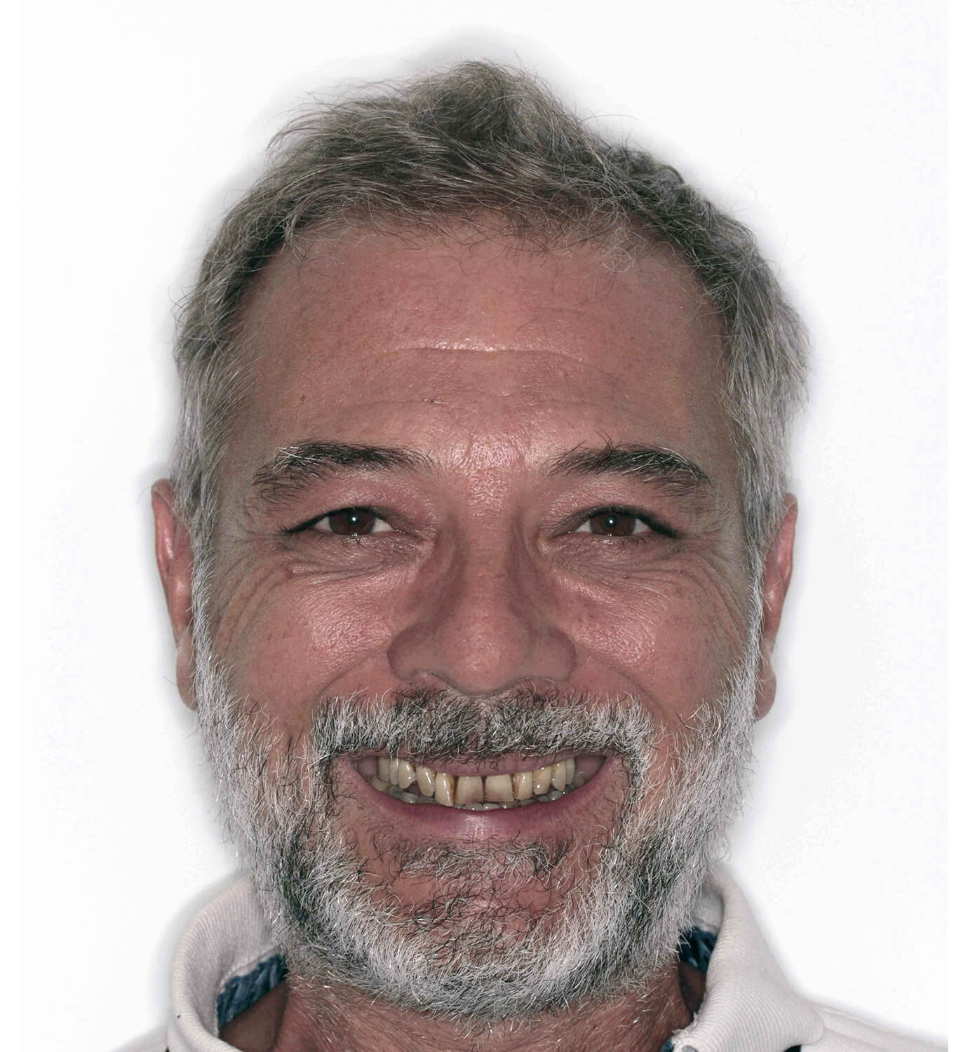 Fotografía de antes de caso con implantes