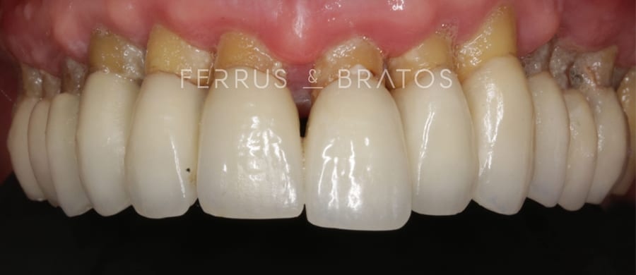 Antes de implantes dentales