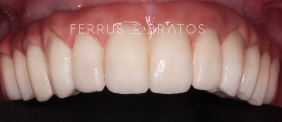 Después de implantes dentales