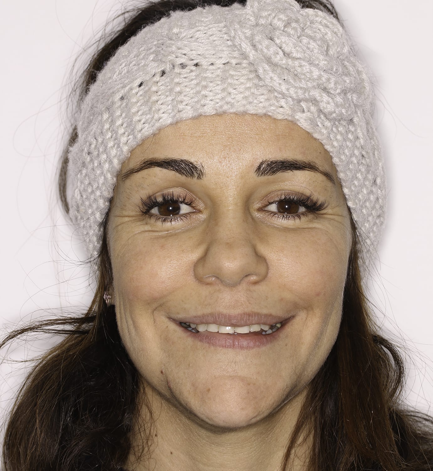 fotografía de después de ortodoncia con Invisalign