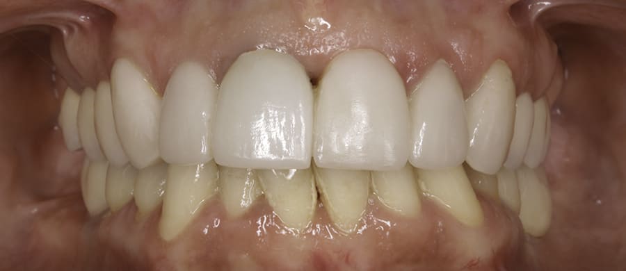 Después de tratamiento periodontal