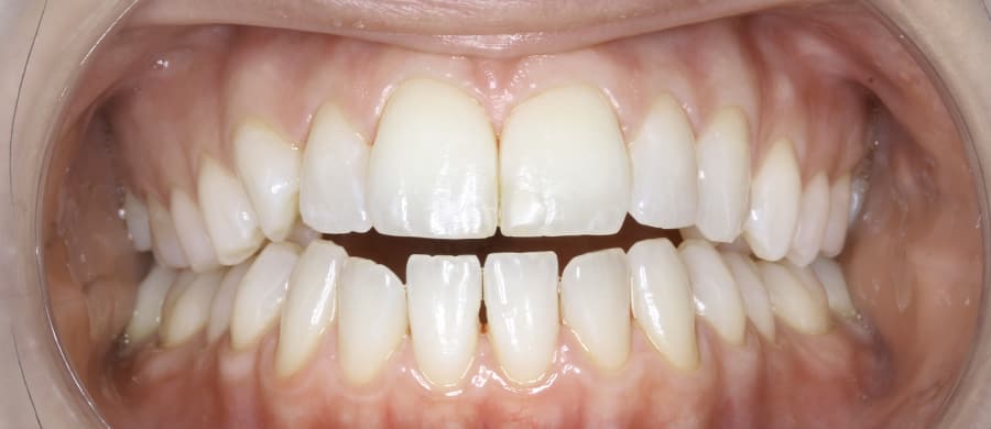 Antes de ortodoncia con Invisalign