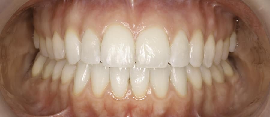 Después de ortodoncia con Invisalign