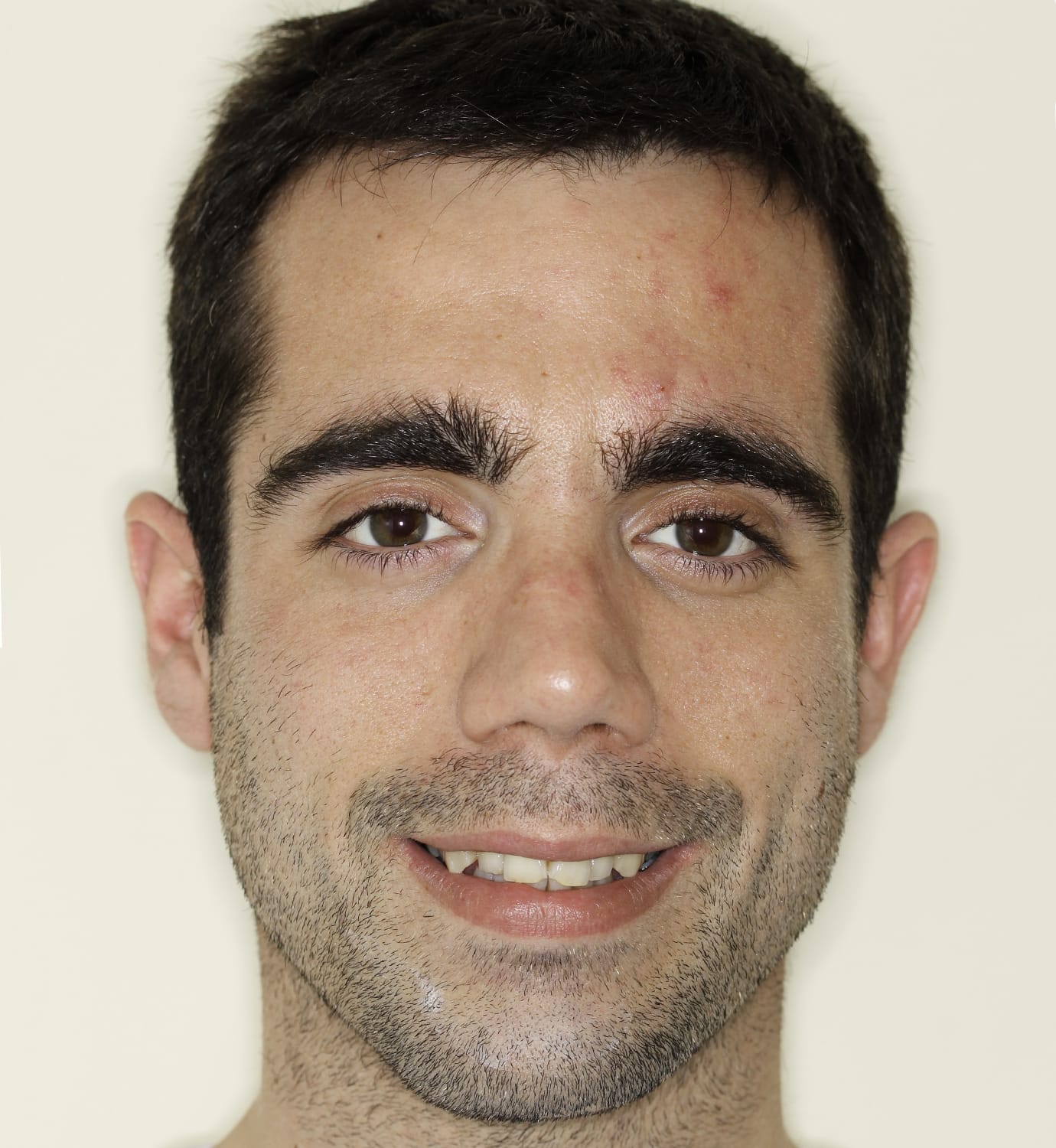 fotografía de antes de ortodoncia con Invisalign