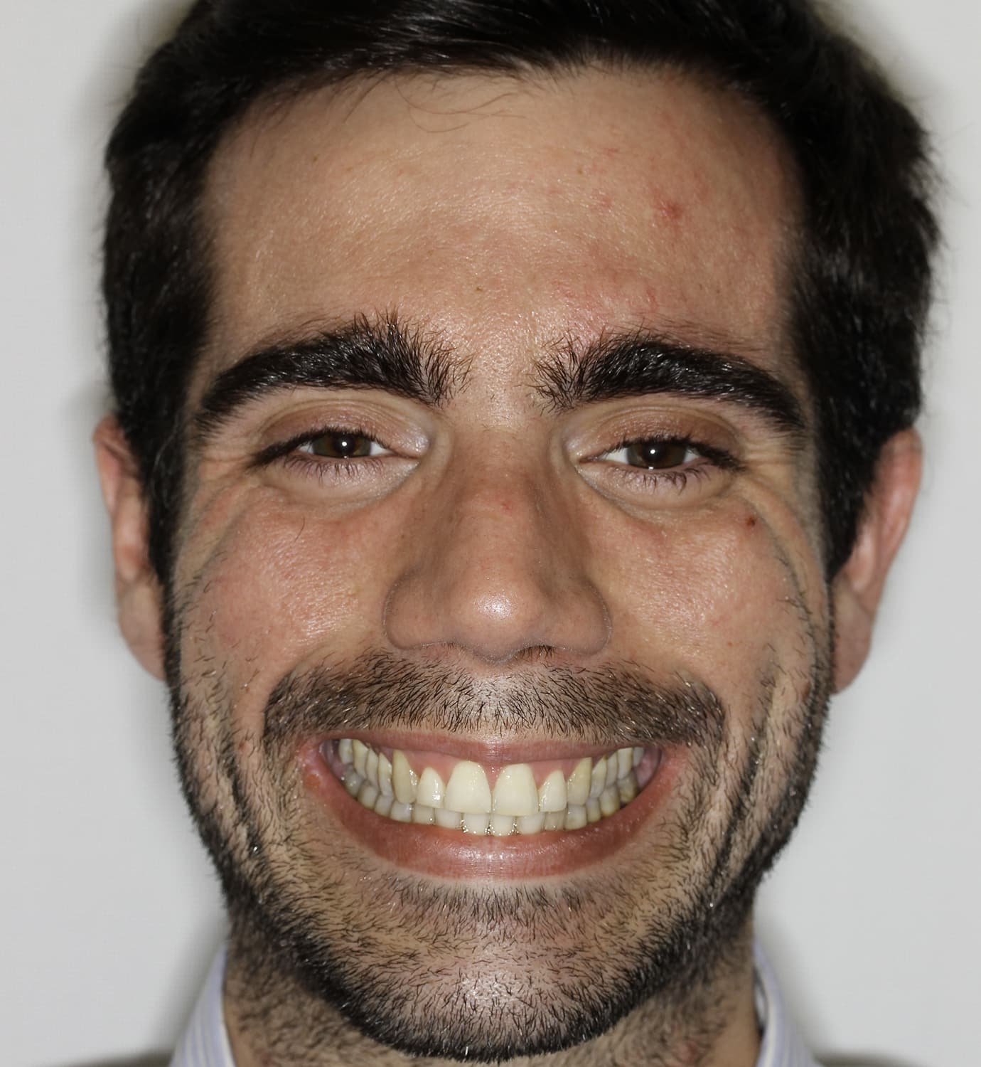 fotografía de después de ortodoncia con Invisalign