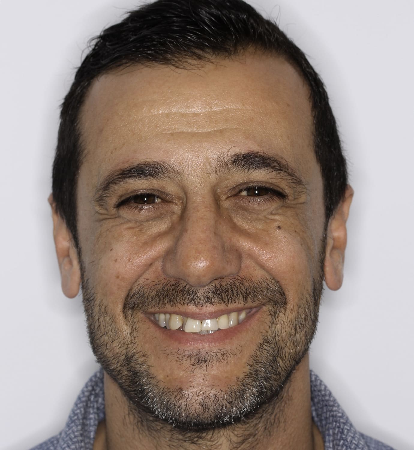 fotografía de sonrisa antes de ortodoncia