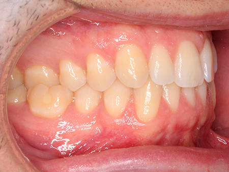Antes