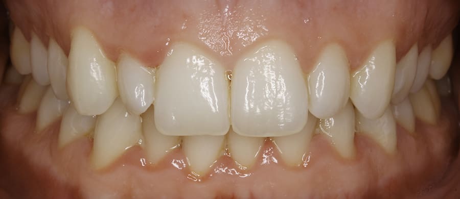 Caso antes de la colocación de carillas dentales