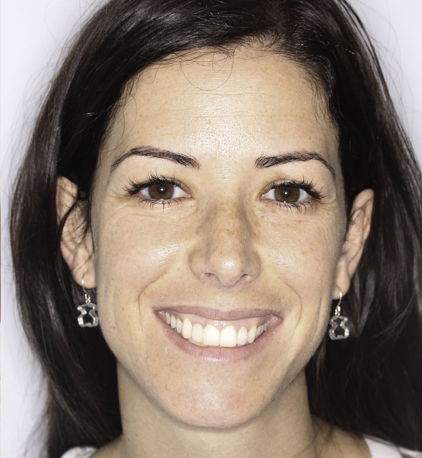 fotografía de antes de ortodoncia con Invisalign