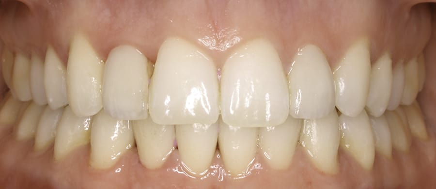 Caso después de la colocación de carillas dentales