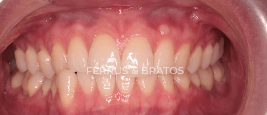 Antes