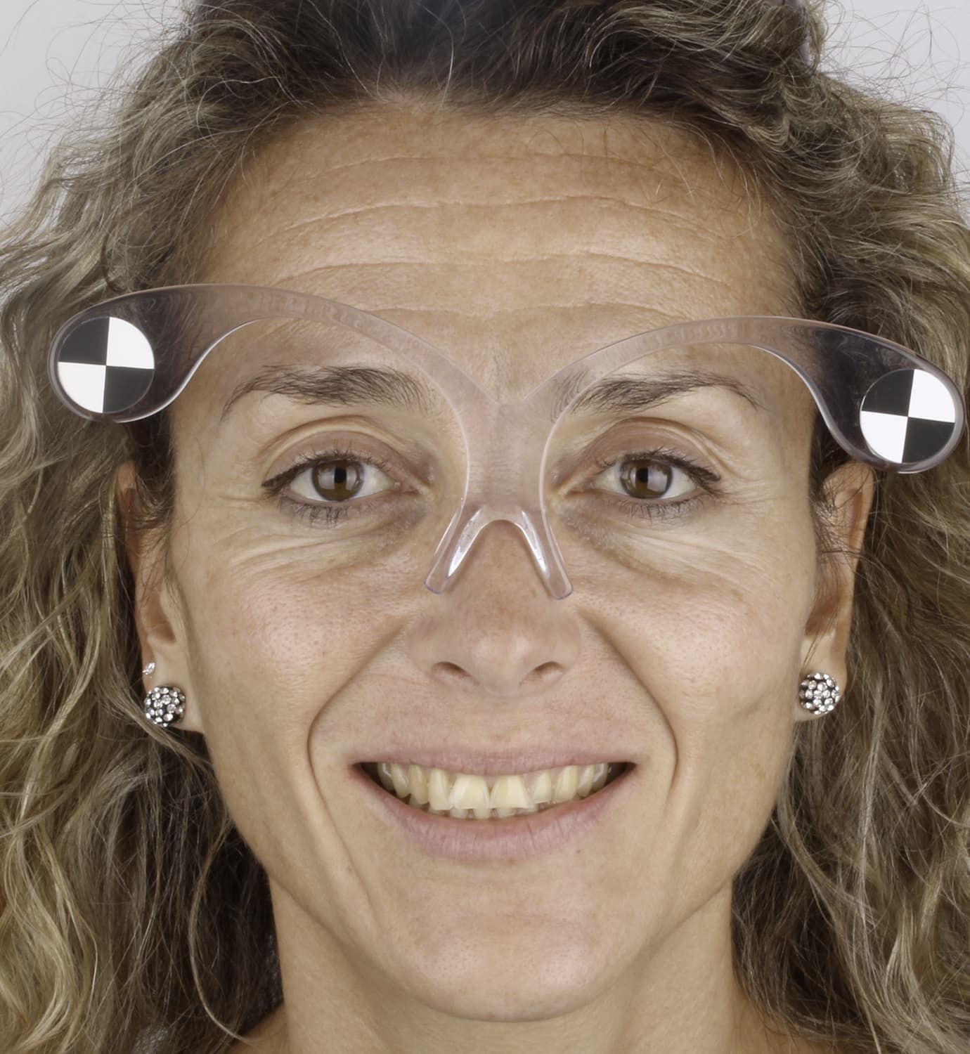 fotografía de antes de carillas dentales