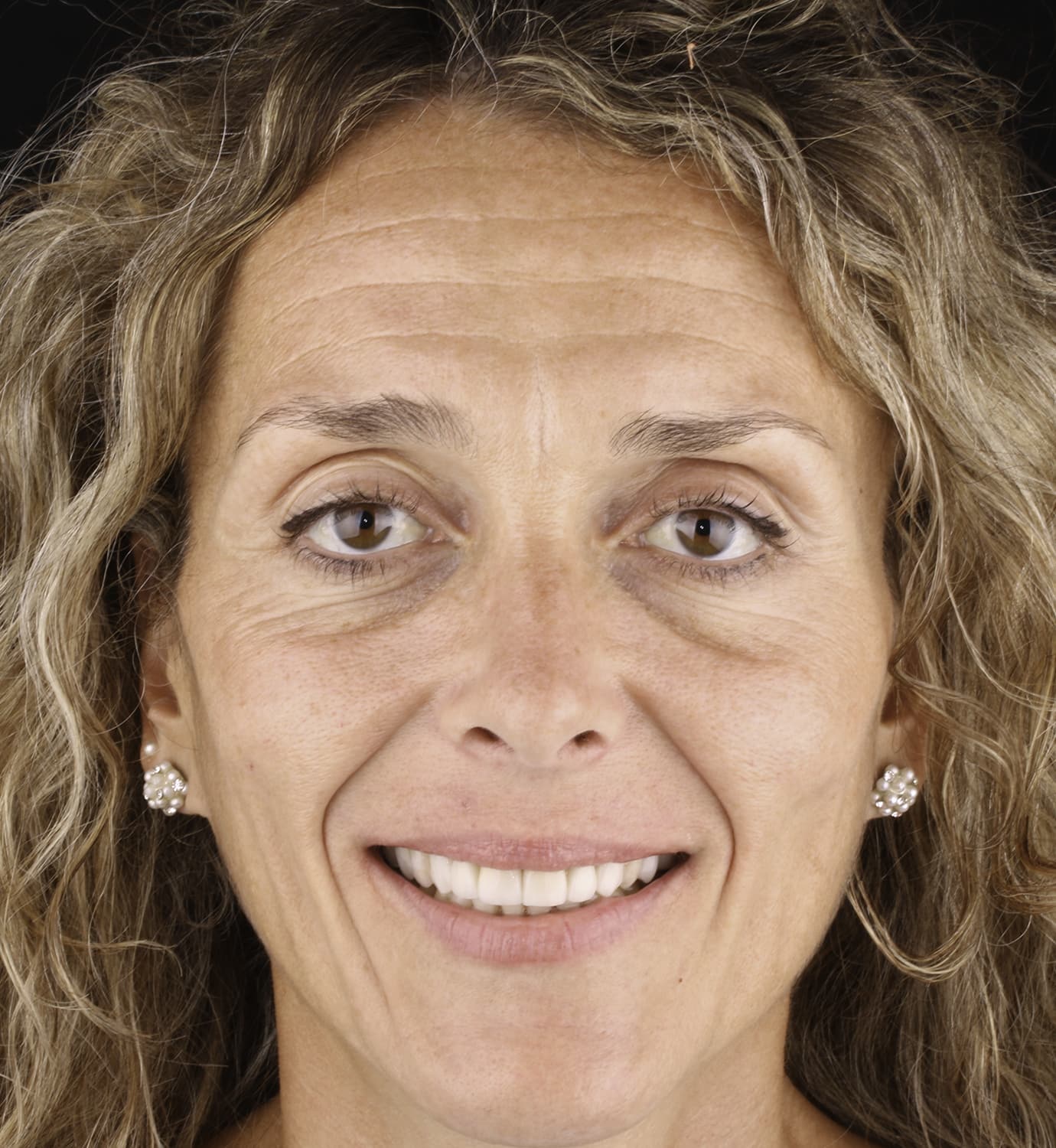 fotografía de después de carillas dentales